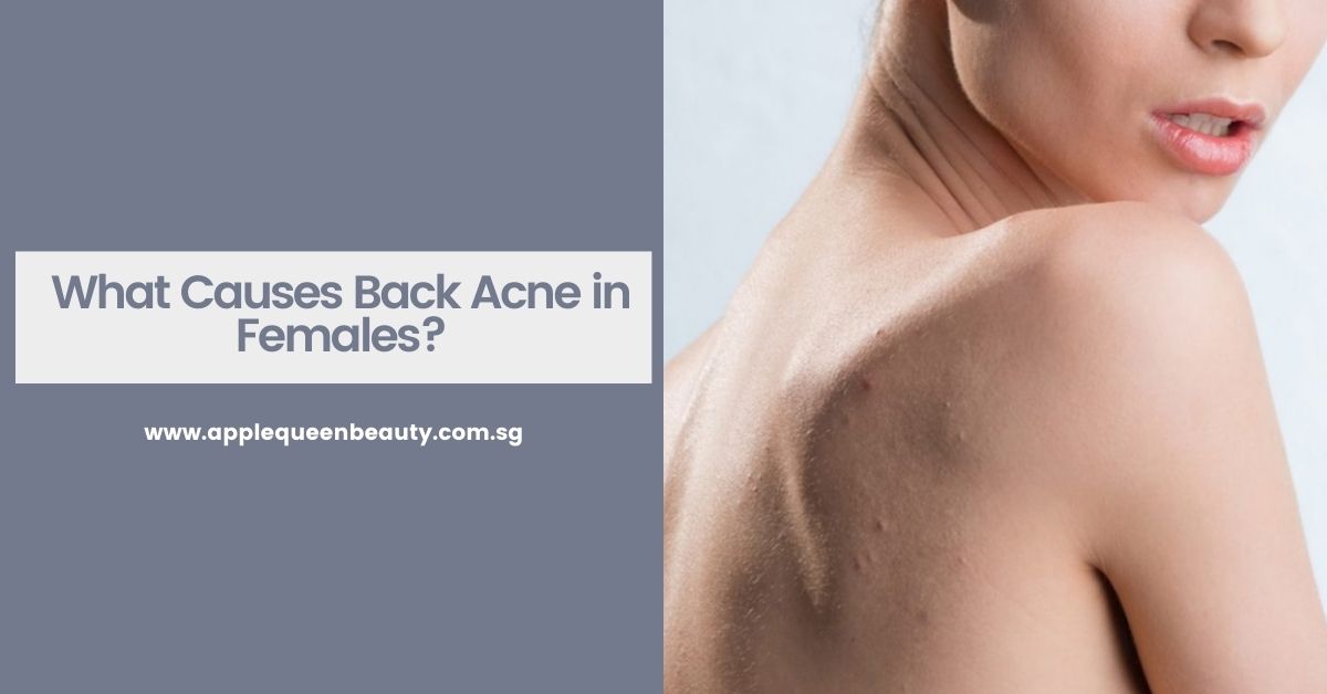 What Causes Back Acne in Females Featured Image