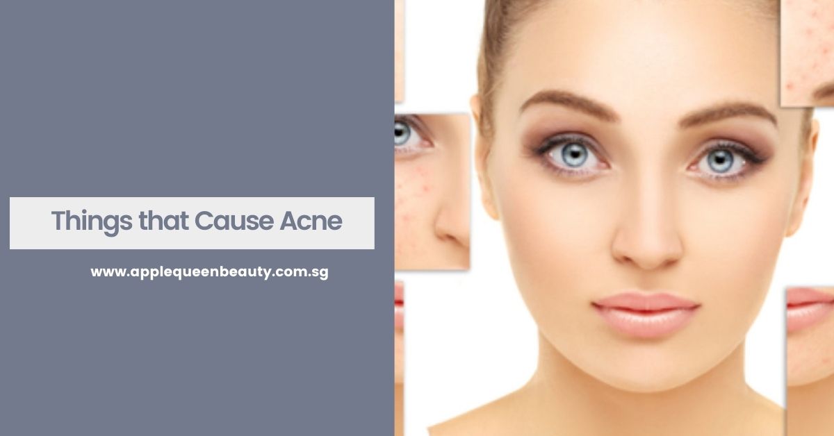 Things that Cause Acne Featured Image