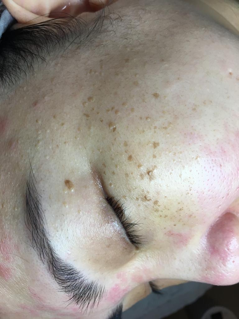 pigmentation freckle